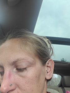 image of Cyndi's eye just a few minutes after she gave herself a black eye